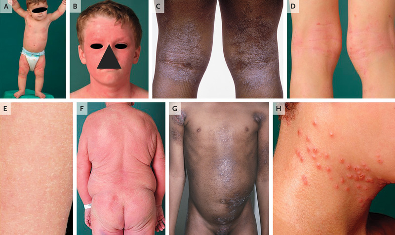 Atopic Dermatitis