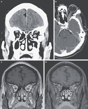 Case 6-2021: A 65-Year-Old Man with Eye Pain and Decreased Vision