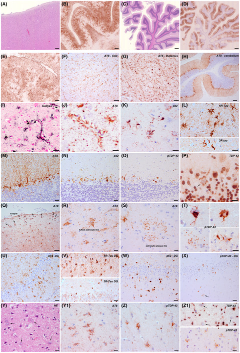 Atypical astroglial pTDP‐43 pathology in astroglial predominant tauopathy