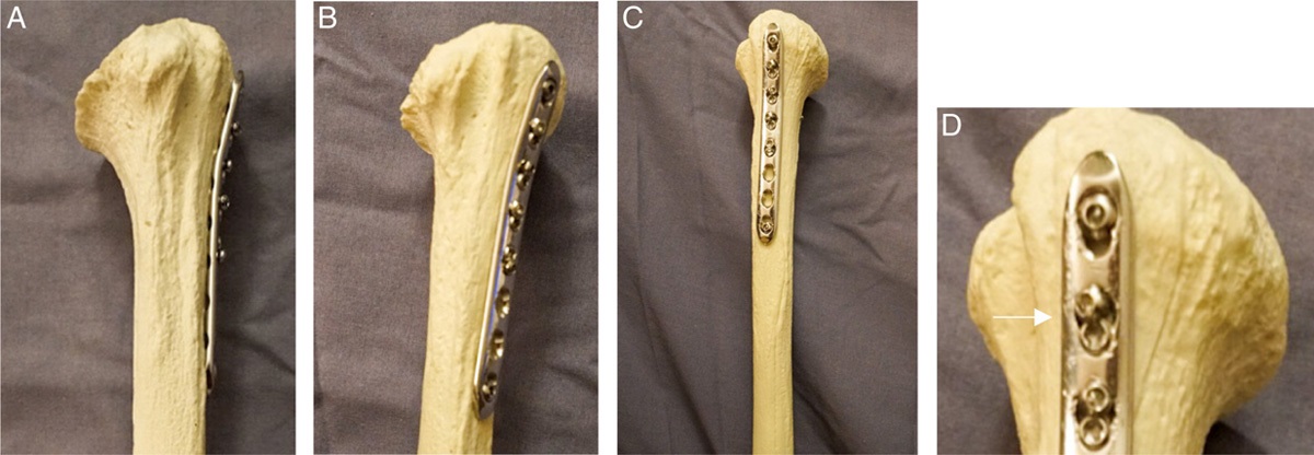 Small Fragment Instrumentation for Periprosthetic Humerus Fracture Fixation Technique