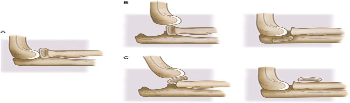 Jeffery Type II Fracture of the Radial Neck of a Child: Description of the Lesion and Novel Method of Closed Reduction