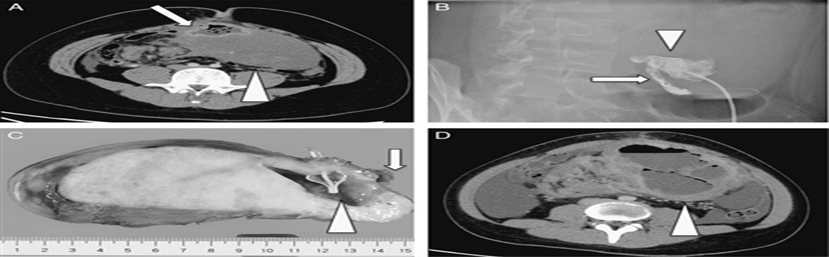 Surgical management of intertumor abscesses caused by fistulous communications with the intestine: rare complication in pediatric malignant tumor: 2 case reports