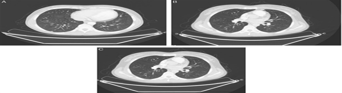 Gestational choriocarcinoma with residual lung tumor after completing treatment: a case report