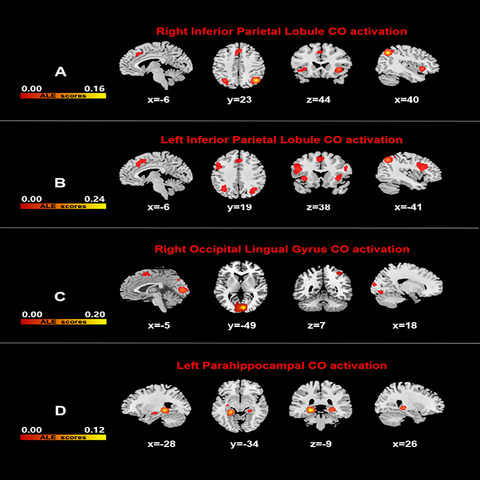 Neuroimaging alterations in dementia with Lewy bodies and neuroimaging differences between dementia with Lewy bodies and Alzheimer's disease: An activation likelihood estimation meta‐analysis