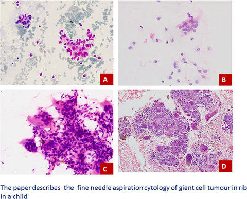 Cytodiagnosis of giant cell tumour presenting at unusual age and site with review of literature