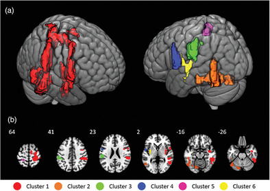 Cerebral processing of sharp mechanical pain measured with arterial spin labeling