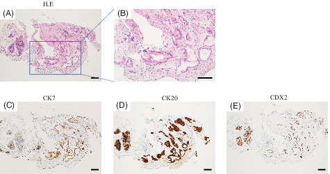 A rare case of urachal carcinoma with multiple lung metastasis that required differentiation from primary lung carcinoma