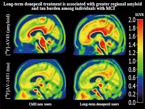 Association between long‐term donepezil treatment and brain regional amyloid and tau burden among individuals with mild cognitive impairment assessed using 18F‐AV‐45 and 18F‐AV‐1451 PET