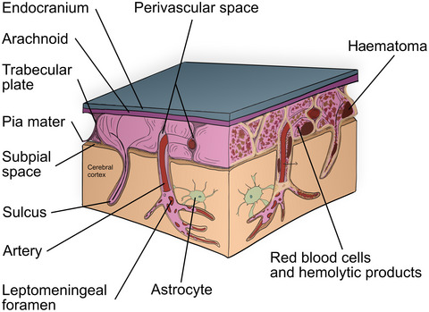 Disturbed cerebral circulation and metabolism matters