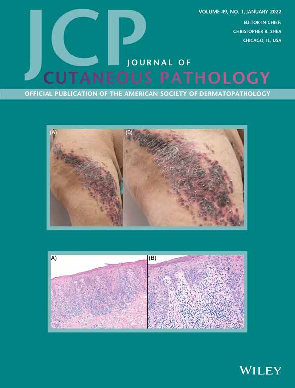 Primary cutaneous natural killer/T‐cell lymphoma presenting as sacrococcygeal and perianal ulcers