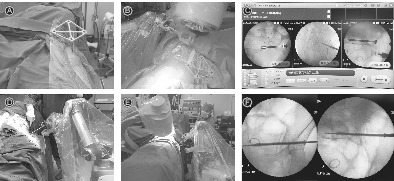Percutaneous Robot‐Assisted versus Freehand S2 Iliosacral Screw Fixation in Unstable Posterior Pelvic Ring Fracture