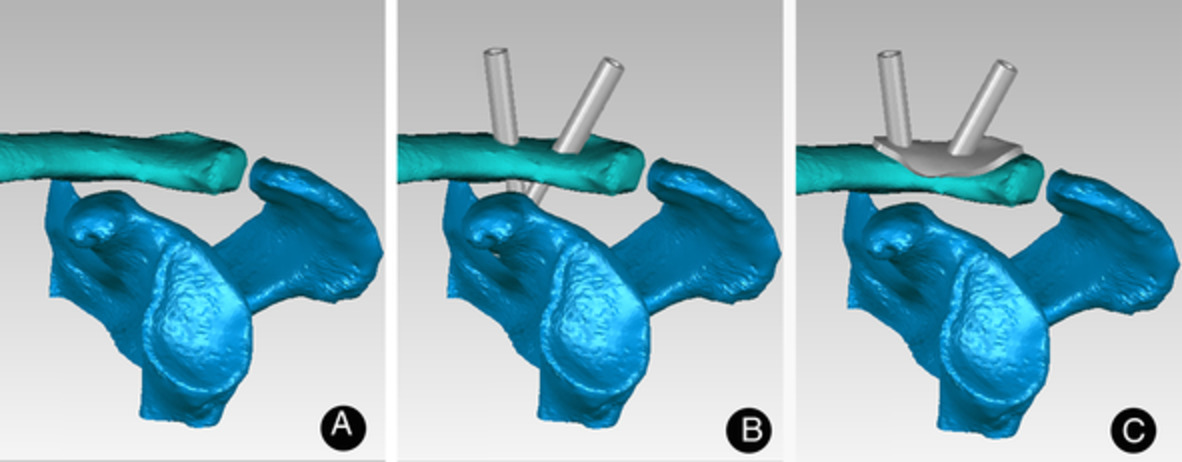 Efficacy of Transosseous Tunnel Placement for Triple Endobutton Plate in Acromioclavicular Joint Reconstruction: A Three‐Dimensional Printing Guide Design Technology