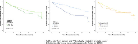 Cribriform architecture outperforms Gleason pattern 4 percentage and tertiary Gleason pattern 5 in predicting the outcome of Grade Group 2 prostate cancer patients