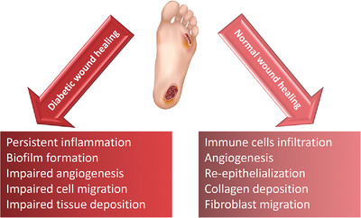 Nanotechnology‐driven advances in the treatment of diabetic wounds