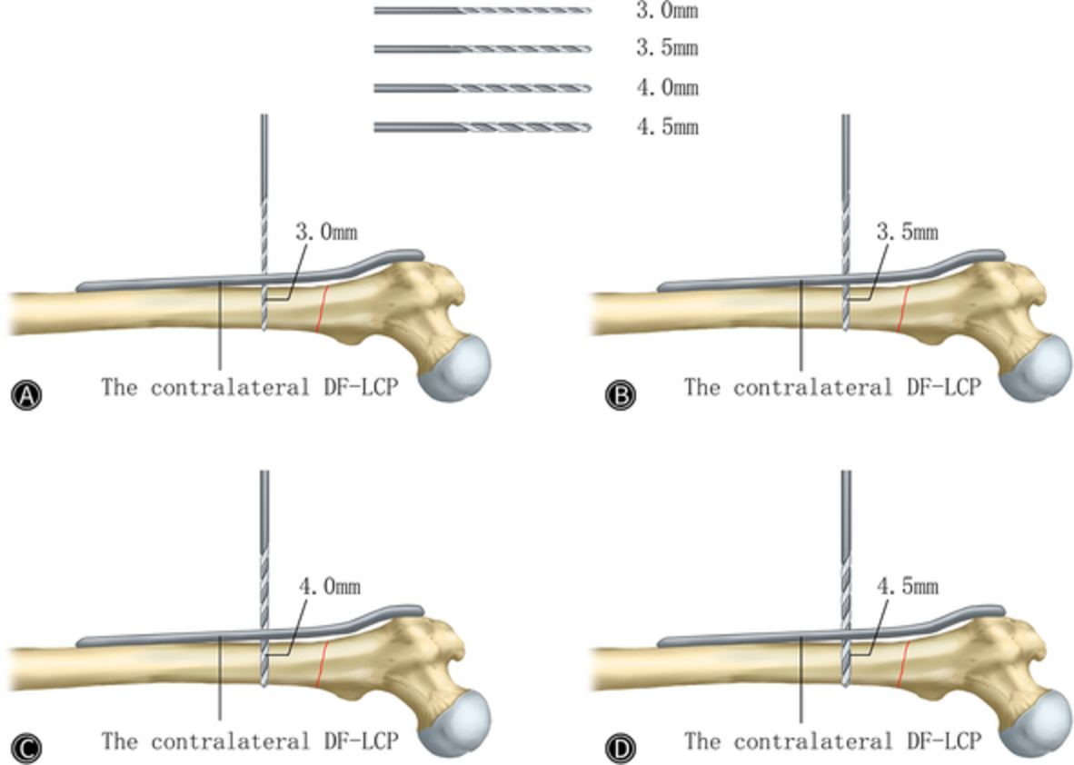 The Treatment of Subtrochanteric Fracture with Reversed Contralateral Distal Femoral Locking Compression Plate (DF‐LCP) Using a Progressive and Intermittent Drilling Procedure in Three Osteopetrosis Patients