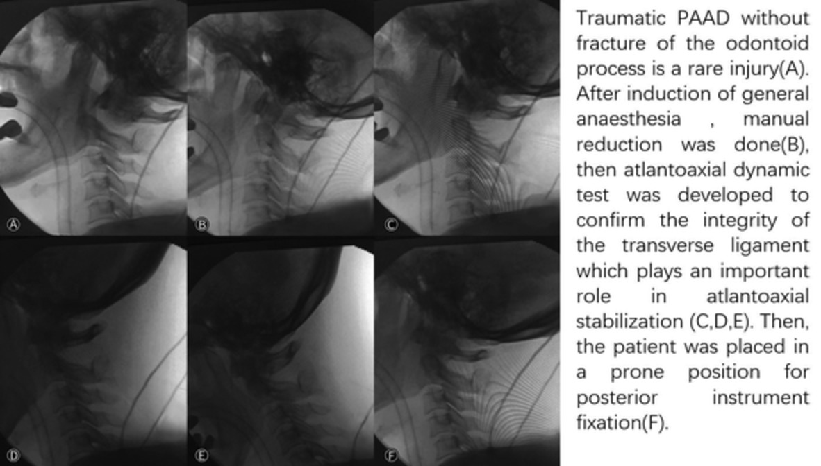 Surgical Management for Posterior Atlantoaxial Dislocation without Fracture and Atlantoaxial Dynamic Test to Confirm the Integrity of the Transverse Ligament: A Case Report