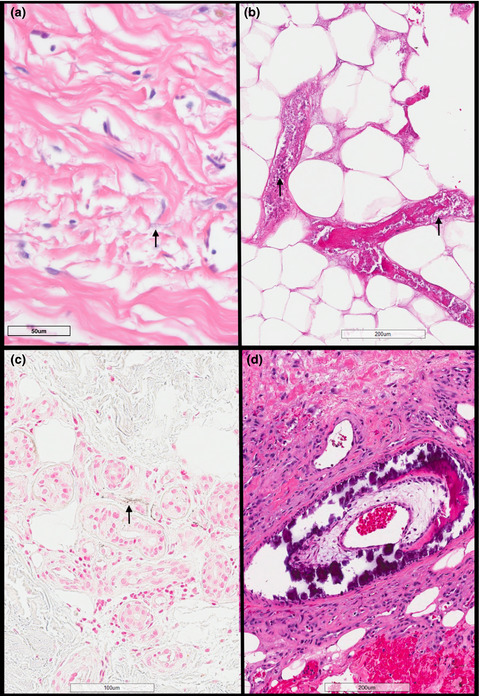 Calciphylaxis in uraemic and nonuraemic settings: clinical risk factors and histopathological findings