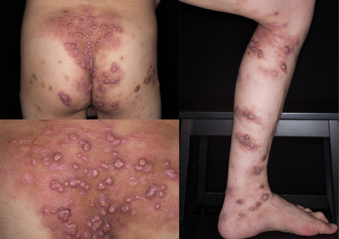 Skin abscesses, X‐linked agammaglobulinaemia and spastic paraplegias in a male patient