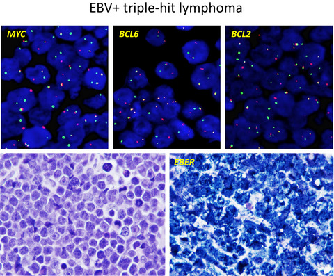 EBV+ high‐grade B cell lymphoma with MYC and BCL2 and/or BCL6 rearrangements: a multi‐institutional study