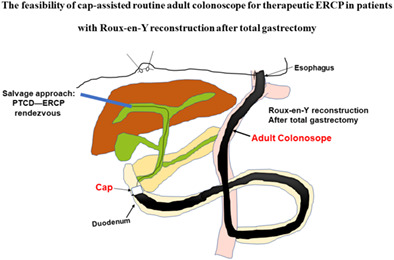 The feasibility of cap‐assisted routine adult colonoscope for therapeutic endoscopic retrograde cholangiopancreatography in patients with Roux‐en‐Y reconstruction after total gastrectomy