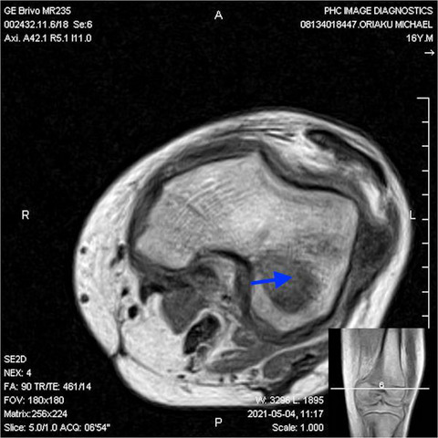 Osteomyelitis infection disguised as Reiter's syndrome in a child: A case report