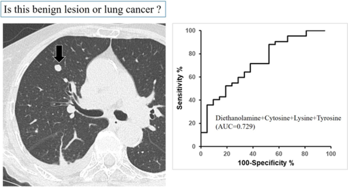 Differential diagnosis of lung cancer and benign lung lesion using salivary metabolites: A preliminary study