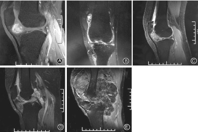 A New Simple and Practical Clinical Classification for Tenosynovial Giant Cell Tumors of the Knee