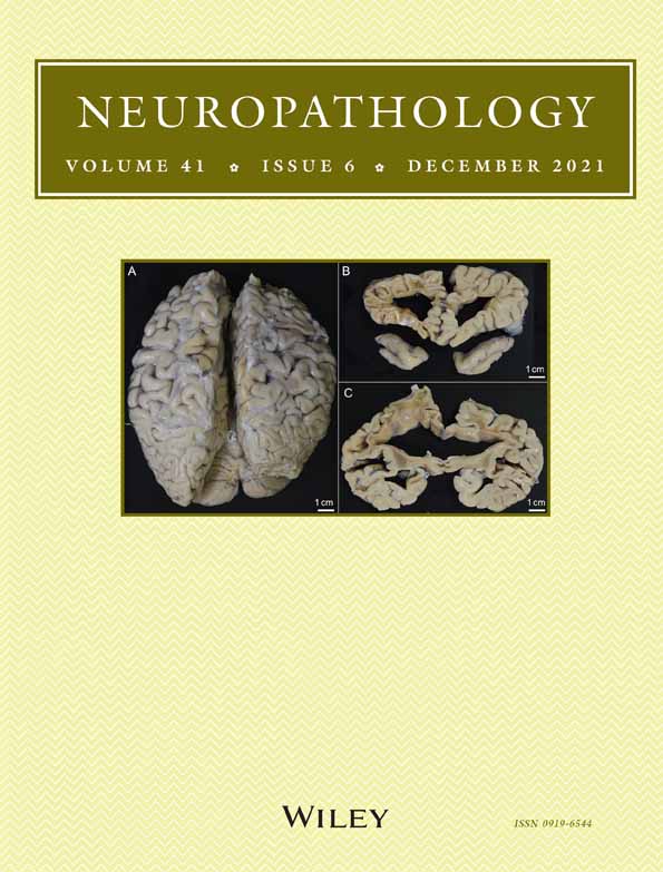 Tufted astrocyte‐like glia in two autopsy cases of multiple system atrophy: Is it a concomitant neurodegenerative disorder with multiple system atrophy and progressive supranuclear palsy?