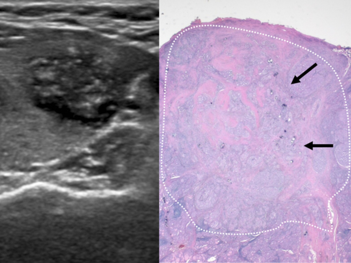 Histopathological correlation of punctate echogenic foci on ultrasonography in papillary thyroid carcinoma