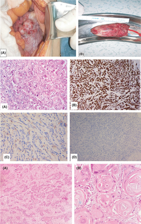 Malignant transformation of mature cystic teratoma into undifferentiated carcinoma: A case report