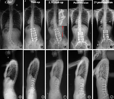 Failed Primary Surgery in Congenital Scoliosis Caused by a Single Hemivertebra: Reasons and Revision Strategies