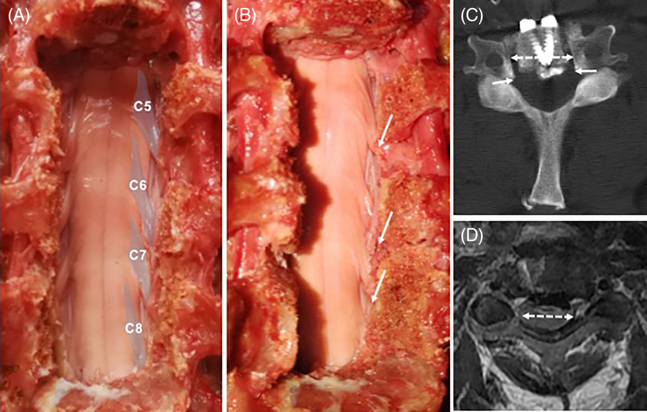 Anatomical Evaluation of Spinal Nerve and Cervical Intervertebral Foramina in Anterior Controllable Antedisplacement and Fusion Surgery: A Cadaveric and Radiologic Study