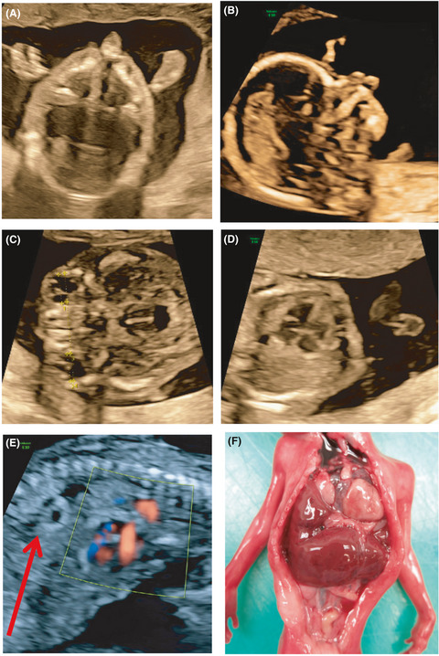 A novel nonsense variant in MED12 associated with malformations in a female fetus