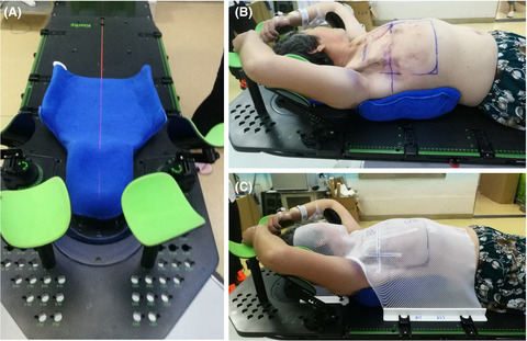 A clinical trial to compare a 3D‐printed bolus with a conventional bolus with the aim of reducing cardiopulmonary exposure in postmastectomy patients with volumetric modulated arc therapy