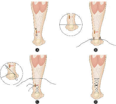 The Reinforced Ma–Griffith Method Combined with Minimally Invasive Small‐Incision Suture for Acute Achilles Tendon Rupture