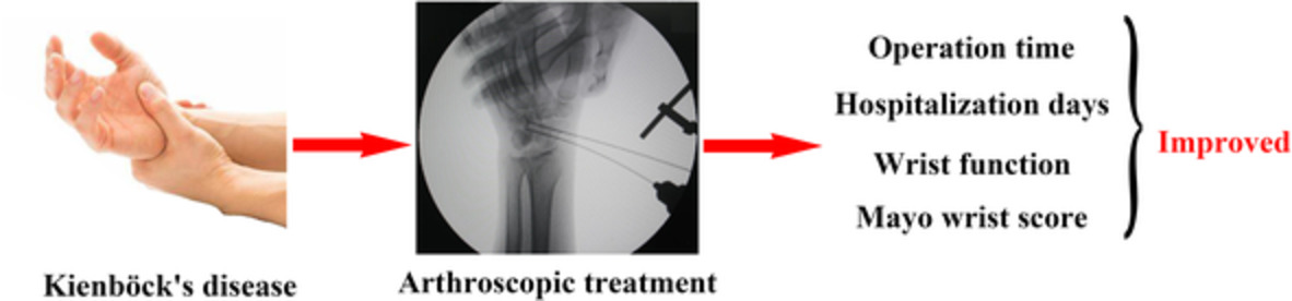 Evaluation of the efficacy of wrist arthroscopic surgery for aseptic necrosis of lunate bone