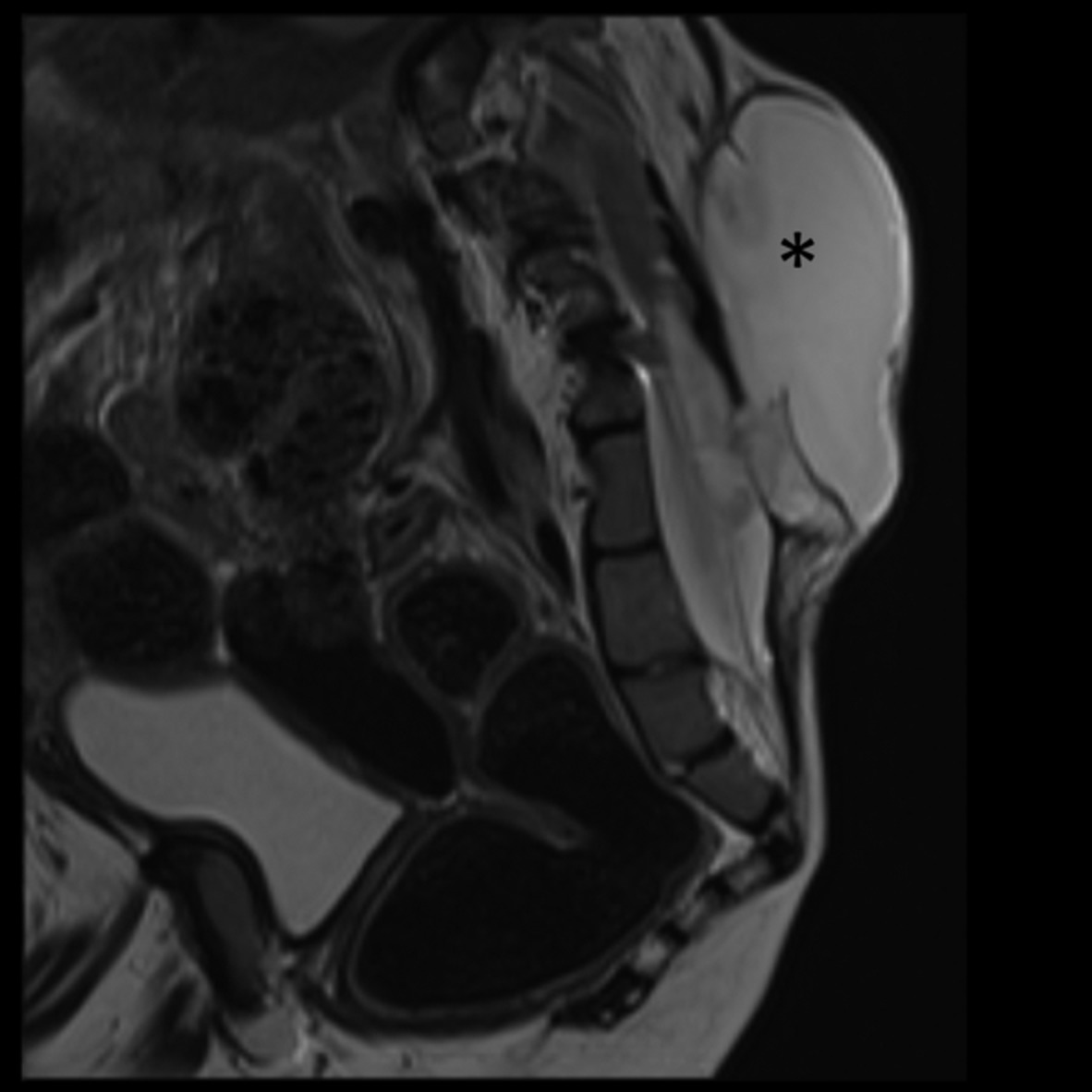 Combined ultrasound and fluoroscopy guided tunneled external lumbar drain placement in children