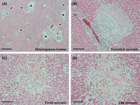 Nivolumab‐induced liver injury with a steroid‐refractory increase in biliary enzymes, in a patient with malignant mesothelioma: An autopsy case report