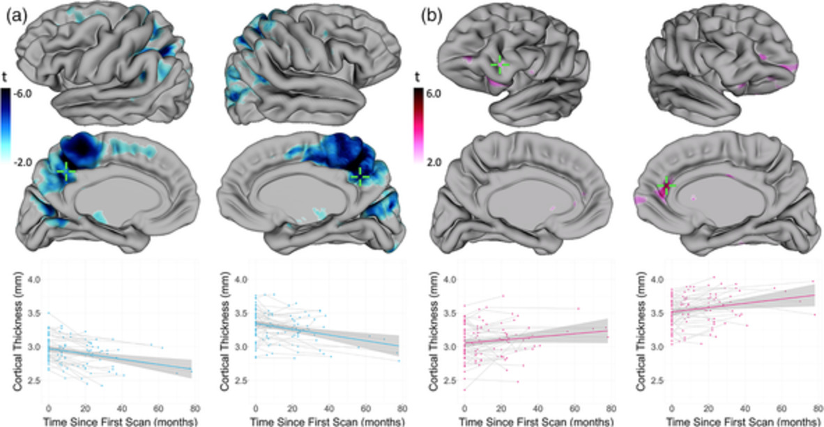 Patterns of change in cortical morphometry following traumatic brain injury in adults