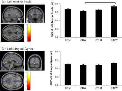 Common and gender‐specific associations with cocaine use on gray matter volume: Data from the ENIGMA addiction working group