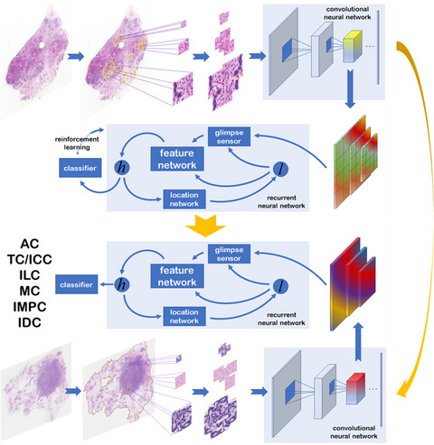 Artificial intelligence for histological subtype classification of breast cancer: combining multi‐scale feature maps and recurrent attention model