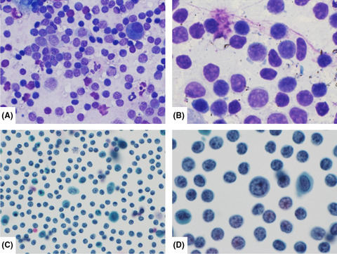 Flow cytometric immunophenotyping in a liquid‐based cytology sample of pleural fluid: Connecting the dots