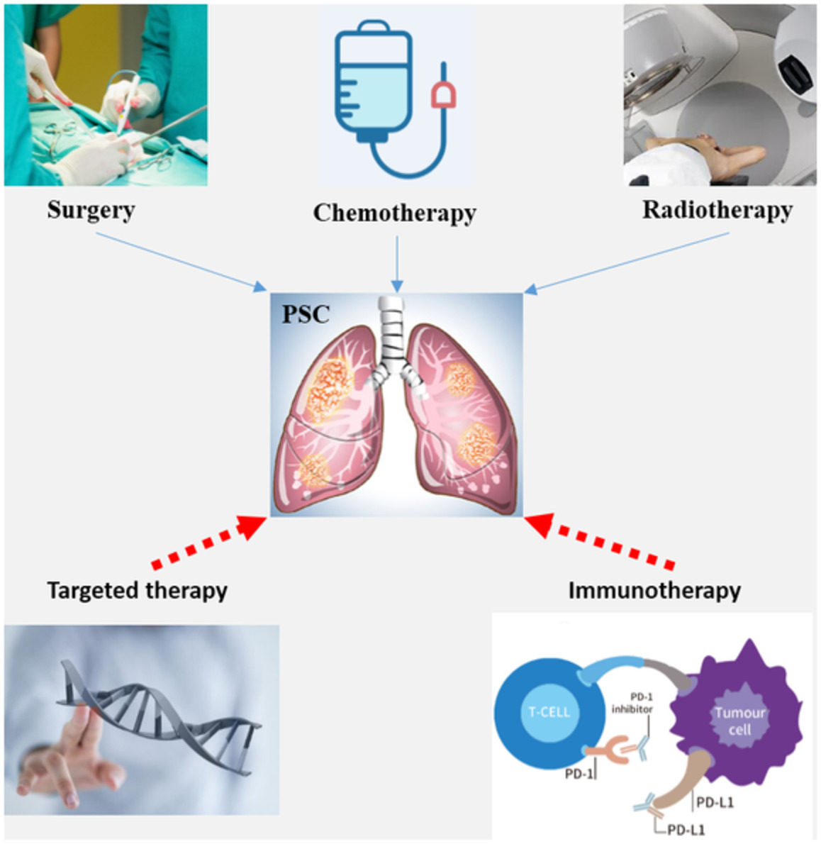 Use of PD‐1 inhibitor tislelizumab in the treatment of advanced pulmonary sarcomatoid carcinoma: A case report