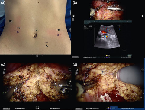 Robotic vs open distal pancreatectomy: A multi‐institutional matched comparison analysis