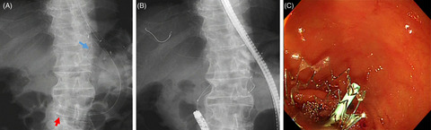 EUS‐guided antegrade pancreatic guidewire placement for double‐guidewire technique in single‐balloon enteroscope‐assisted ERCP