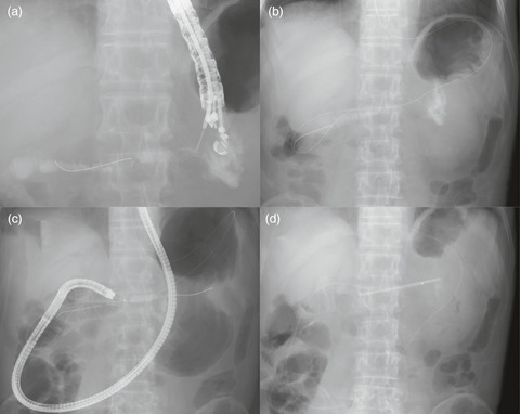 EUS‐guided drainage for a non‐dilated pancreatic duct using a re‐puncture technique in a patient with stricture‐related pancreatitis (with video)