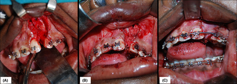 An innovative approach in the management of alveolar clefts with bone graft harvest from maxillary tuberosity and mandibular wisdom molar odontectomy sites: A case report