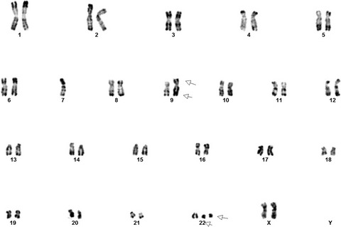 A prognostic approach on a case of pediatric Philadelphia chromosome‐positive acute lymphoblastic leukemia with monosomy‐7