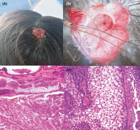 Reddish multilobulated mass on the scalp in a 13‐year‐old girl