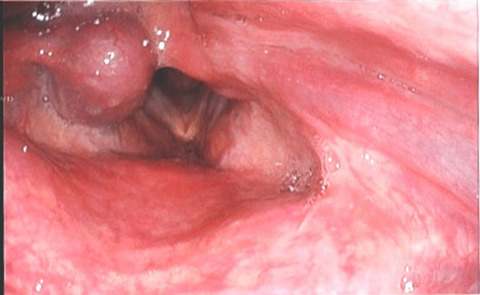 Rare case of angiomyolipoma of the larynx